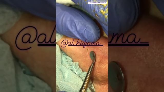 Давилки ? чистка лица