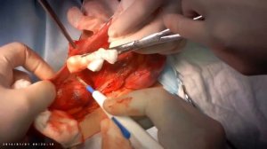 Пластика Лихтенштейна при пахово-мошоночной грыже