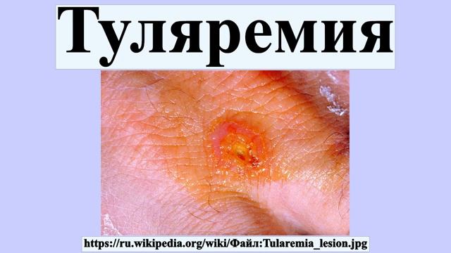 Туляремия смотреть онлайн