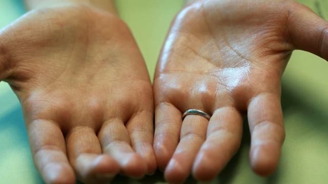 Почему часто потеют ладони? смотреть онлайн