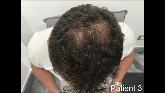 ForHair's Topical finasteride -Start Growing Your Hair! смотреть онлайн