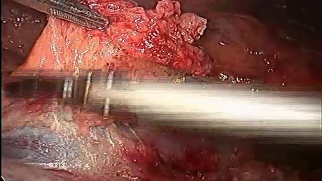 Laparoscopic retroperitoneal lymph node dissection смотреть онлайн
