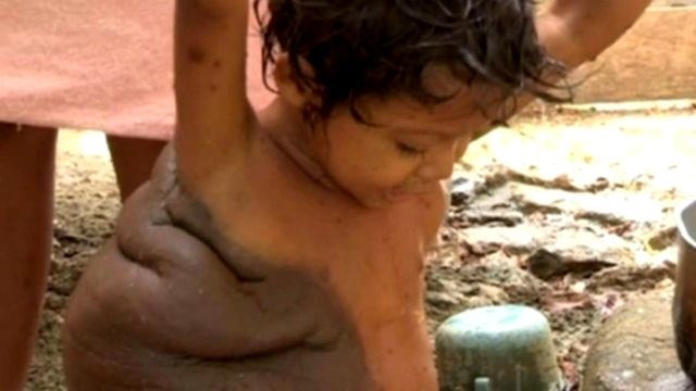 Этот мальчик родился с родинкой на спине. Только посмотрите, что с ним стало к 6 годам!