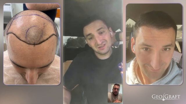 ПЕРЕСАДКА ВОЛОС в GeoGRAFT, ПАРИКМАХЕР В ШОКЕ! смотреть онлайн