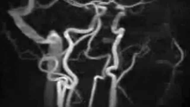 МРА головного мозга