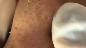 Удаление Угрей, Удаление Прыщей,