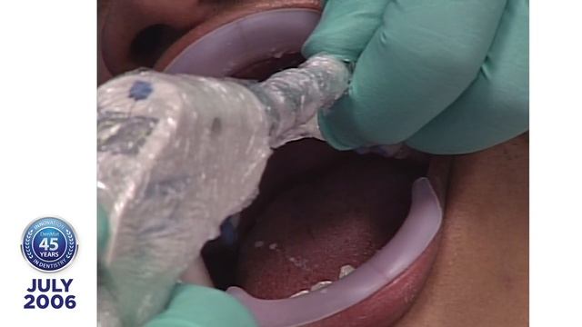 Dr. Robert Ibsen Presents Jay R., a Lumineers® Clinical Case Presentation: 2006 смотреть онлайн