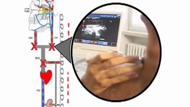 CCSVI nella Sclerosi Mulitpla! Scoperta dal Prof Zamboni dell'Università di Ferrara. смотреть онлайн