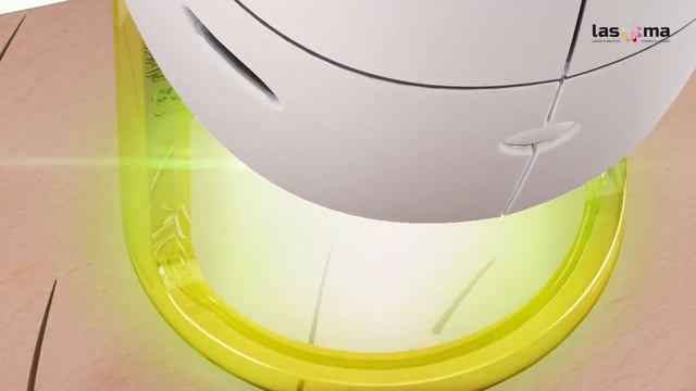Trvalá laserová epilácia CANDELA gentleLASE pro v LASOMA laser&medical cosmetic studio смотреть онлайн