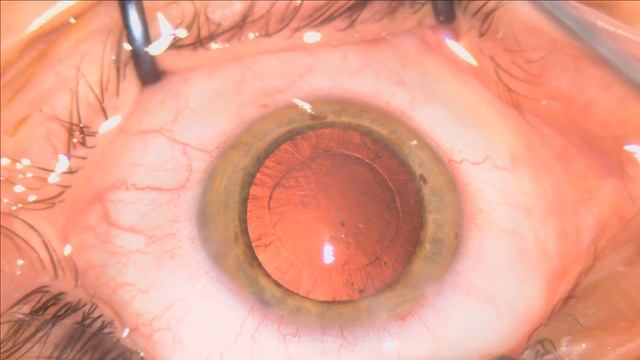 Oculentis LS313MF15 Comfort Lukan Mishev Live Stream смотреть онлайн