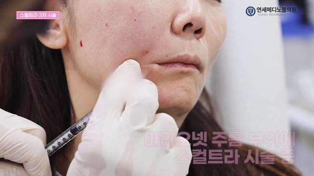40대 여성의 고민 처진피부-스컬트라 시술과정 (3차시술) смотреть онлайн