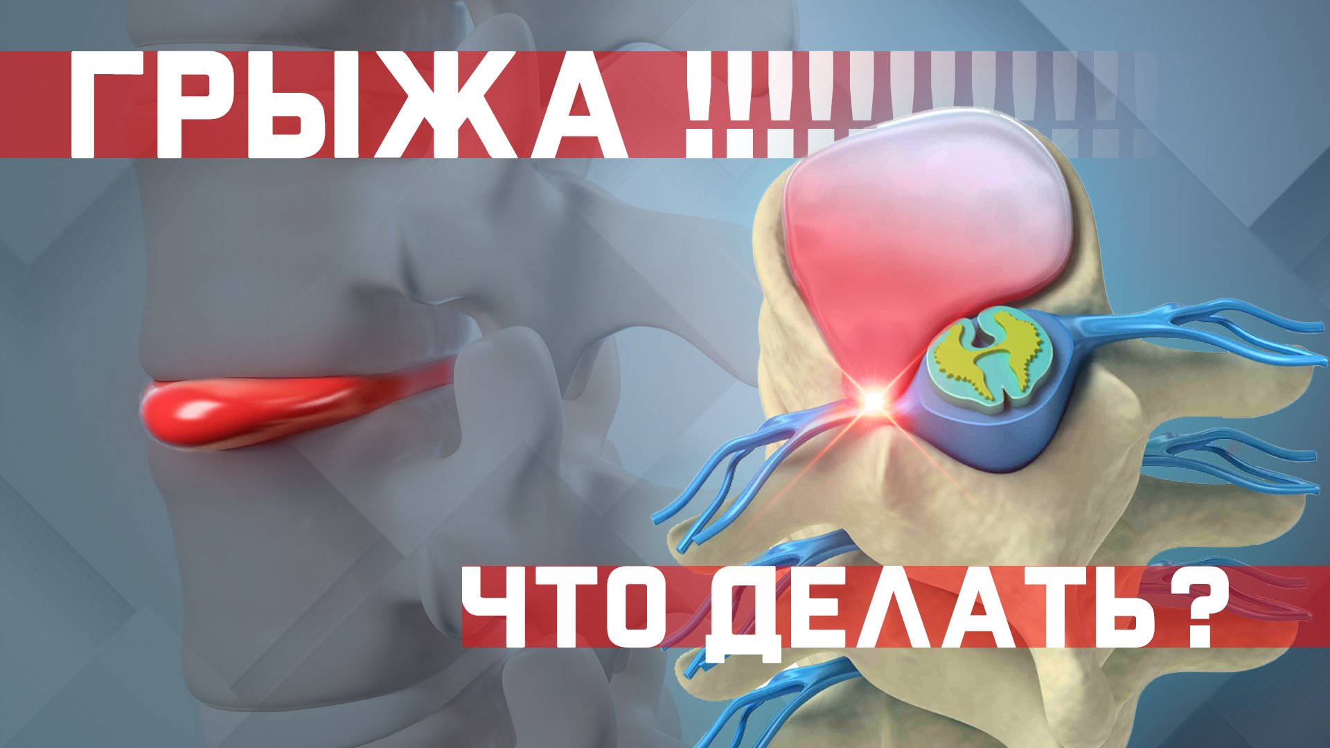 Как лечить межпозвоночную грыжу? Как жить с грыжей? Что с ней делать? смотреть онлайн