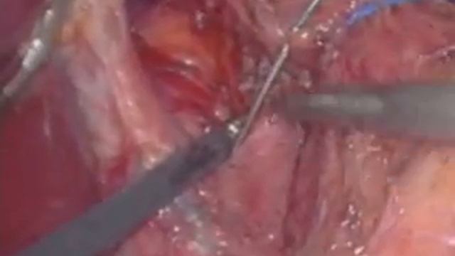 Minimizing Complications in Re-Do Laparoscopic Nissen Fundoplication: Principles and Technique смотреть онлайн