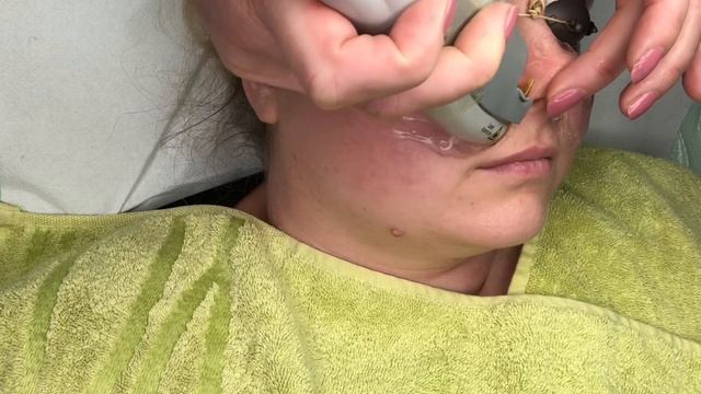 Laser Vein Removal for facial redness reduction, clear skin with Cutera Nd YAG Laser & Limelight смотреть онлайн