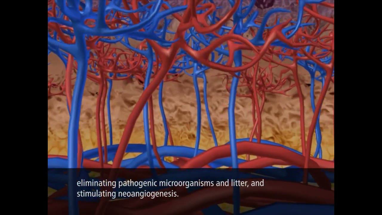 Аппарат УВТ DUOLITH SD1 - заживление ран с помощью аппарата ударно волновой терапии Шторц смотреть онлайн