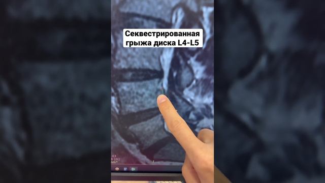 Секвестрированная грыжа L4-L5. #грыжадиска смотреть онлайн