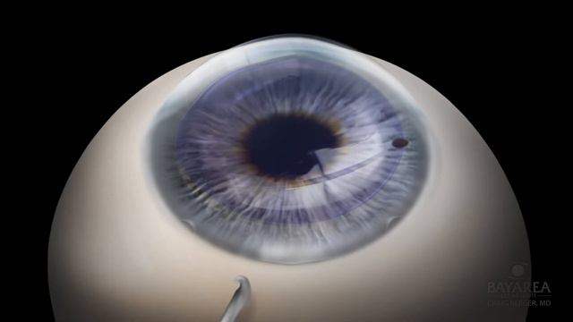 DMEK Craig Berger MD Bay Area Eye Institute смотреть онлайн