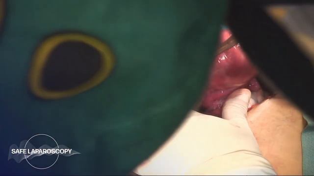 Quick Abdominal Radical Hysterectomy