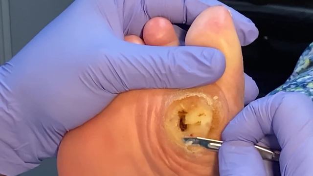 How To Cure Deep Diabetic Ulcers Fast