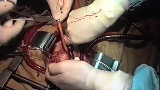 Искусственное и вспомогательное кровообращение