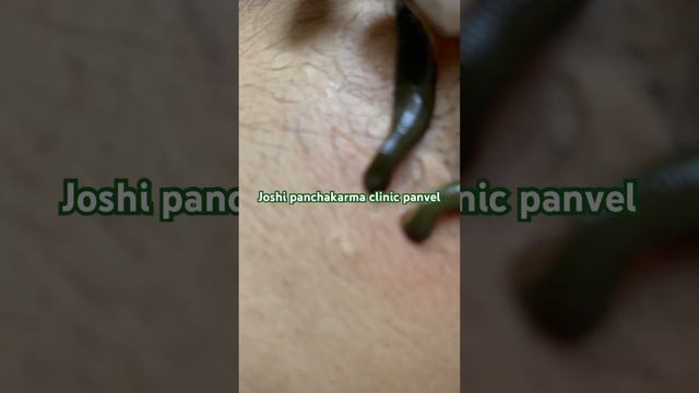 #gerd #gerdtreatment #Epigastric pain #learningayurveda #jaloka #hirudotherapy смотреть онлайн
