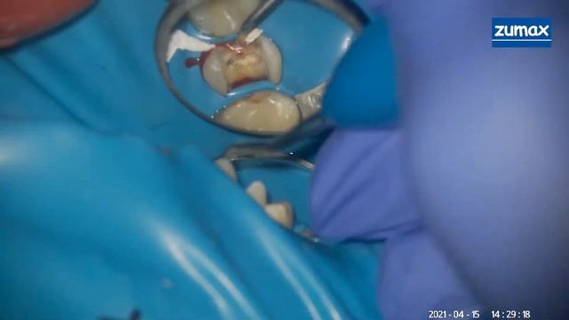 препарирование и изоляция 15го зуба смотреть онлайн