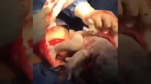 Рождение малыша при помощи Кесарево сечения.