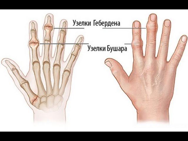 Шишки на пальцах, что это? смотреть онлайн