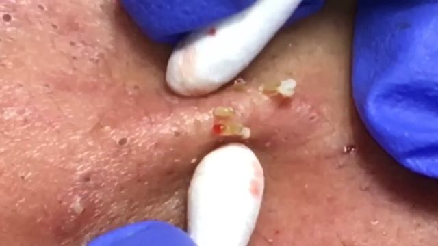 Blackheads Extractions “K’s” 3rd Treatment