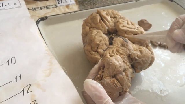 Головной мозг. Продолговатый мозг. Задний мозг. смотреть онлайн