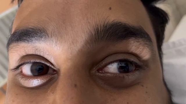 Torsional nystagmus смотреть онлайн