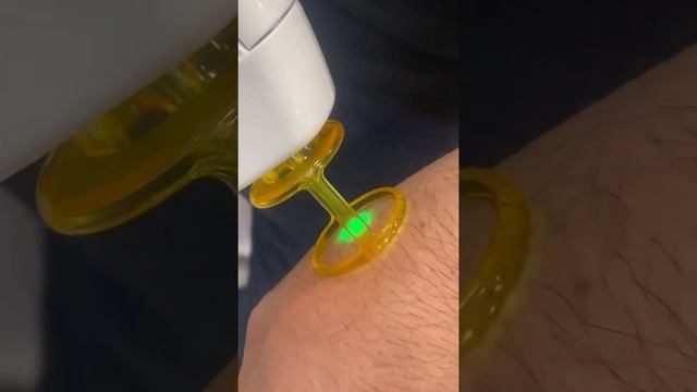 افضل جهاز لازالة الشعر في العراق كاندلا الكسندرايت смотреть онлайн