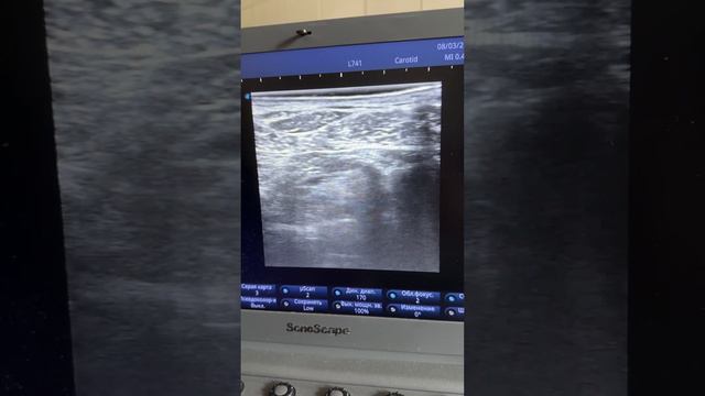 Блокада наружного кожного нерва бедра. смотреть онлайн