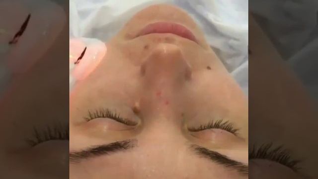 Дарсонвализация лица в Oxygen Clinic