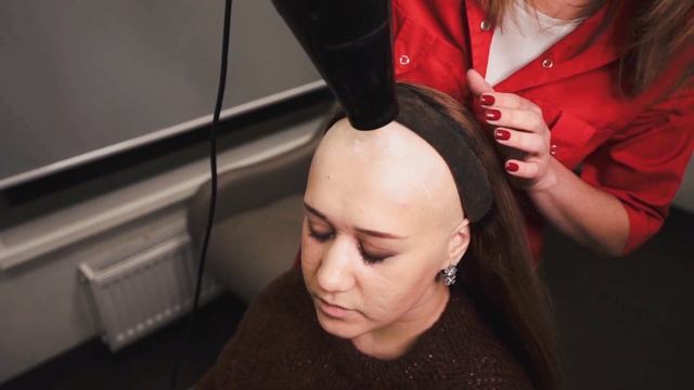 Система волос на сетке при тотальной алопеции смотреть онлайн