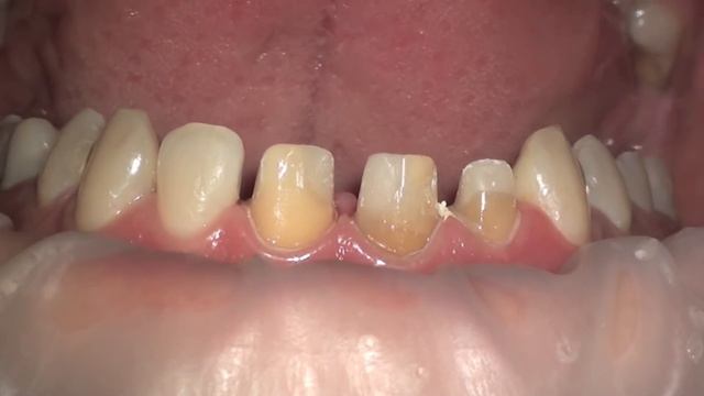 Tooth Preparation Under Microscope, Root Canal Treatment. Nazariy Mykhaylyuk