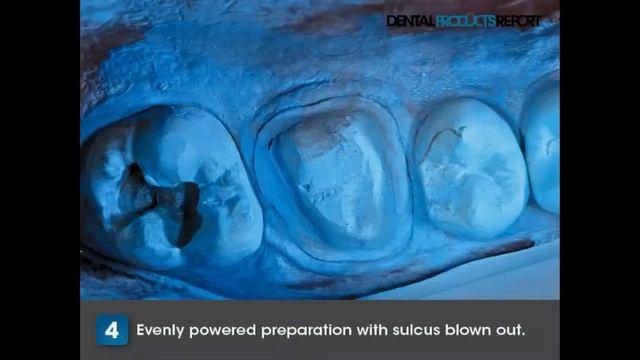 Dental Technique: How To Replace PFMs With Ivoclar Vivadent's IPS E.max