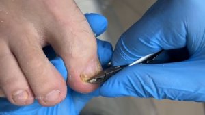 Грибок ногтей / Чем ухаживать дома при грибке ногтей? / Подология / Зачистка ногтя / Грибок на нога