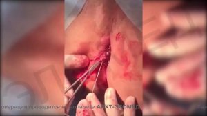 Лазерное лечение геморроя