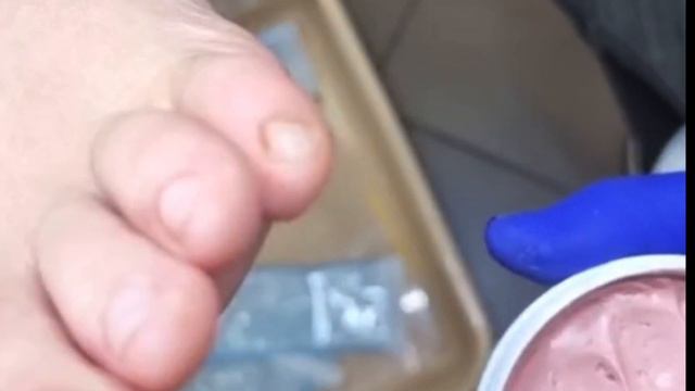 Мозоль между пальцами + разгрузка🦶🏻⚠️🆘 смотреть онлайн