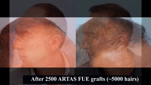Ex England Legend David Platt Has ARTAS Robot FUE Hair Transplant at the Farjo Hair Insitute смотреть онлайн
