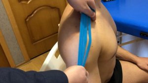 Наложение кинезио тейпа при бурсите плечевого сустава.