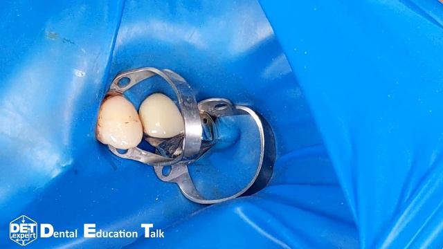 Изоляция зуба 23 клампом B4 с якорным клампом на коронке 25 с консолью 24 DET.expert & Sanctuary 4K