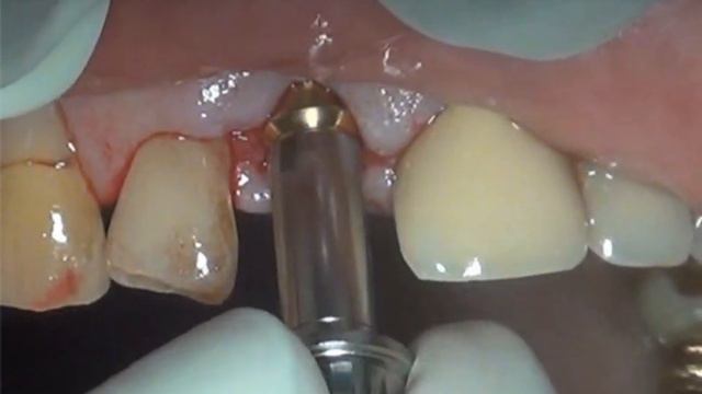 Имплантация и установка временной коронки