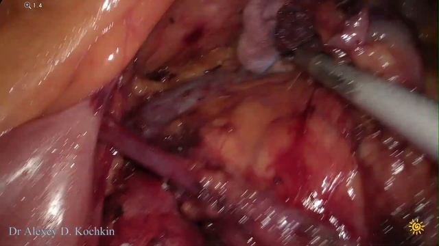 transmesocolic nephrectomy/RPLND/трансмезентериальный доступ/лап нефрэктомия/лимфаденэктомия/Кочкин смотреть онлайн