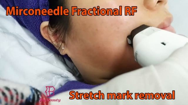 TB-RF03A Mirco needle rf fractional RF machine смотреть онлайн