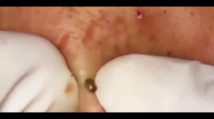 Blackheads Removal / Удаление угря, большой чёрной точки 2019