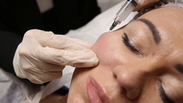 Sculptra - полимолочная кислота смотреть онлайн