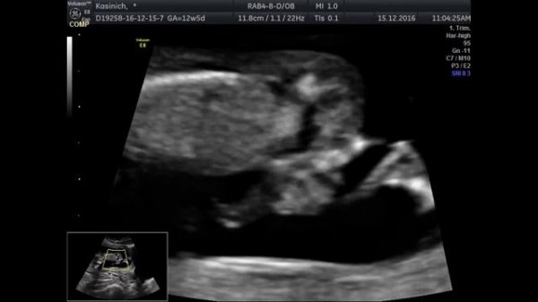 Гастрошизис