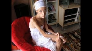 Топ-5 самых худых людей мира. Смертельная анорексия